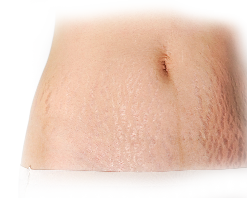 stretch mark removal clinic