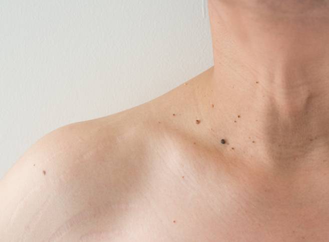 skin tag removal in Hyderabad