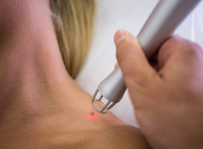 invasive treatment for skin tag removal in Hyderabad
