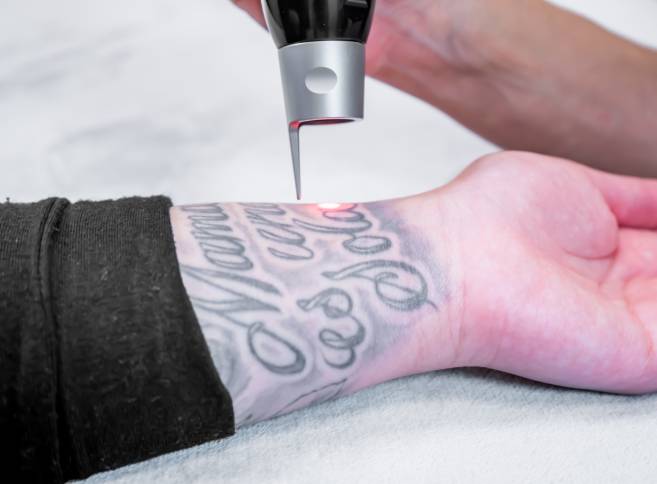 tattoo removal clinic